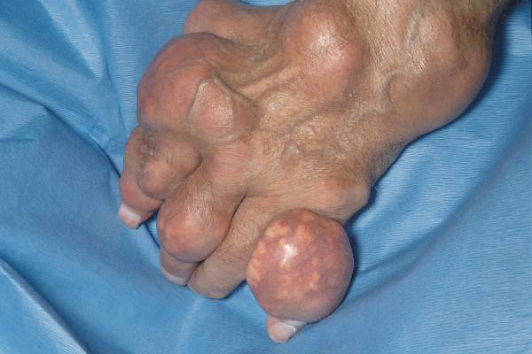 Bàn chân bệnh nhân Gout