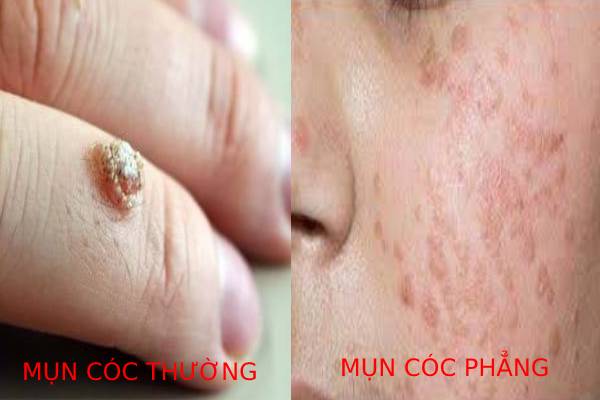 Phân biệt mụn cóc