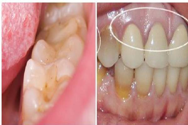 Dấu hiệu nhận biết sâu răng