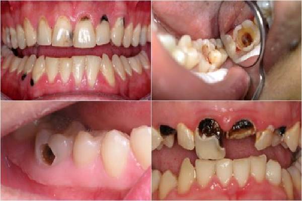 Hình ảnh bệnh sâu răng