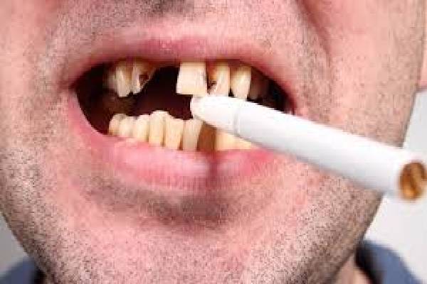 Hút thuốc lá là một trong những nguyên nhân gây nên viêm nha chu