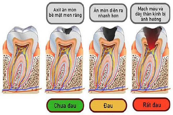 Sâu răng qua 4 giai đoạn
