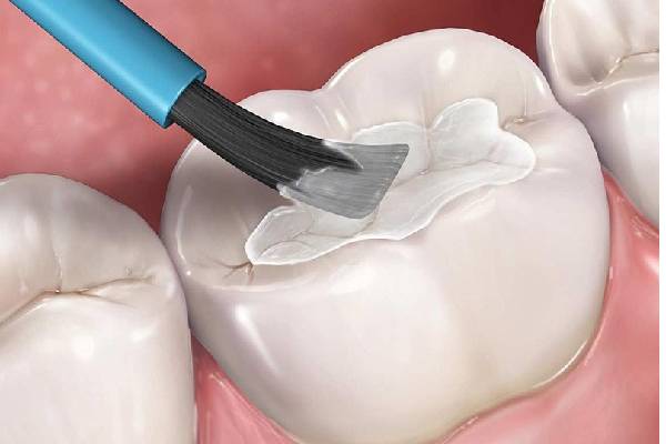 Trám răng là cách điều trị sâu răng hiệu quả