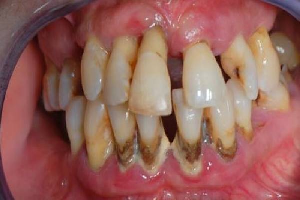 Viêm nha chu - Biến chứng của viêm nướu lợi