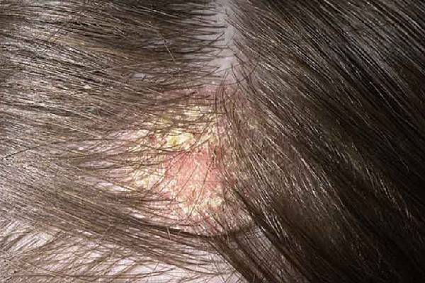 Hình ảnh bệnh nấm da đầu