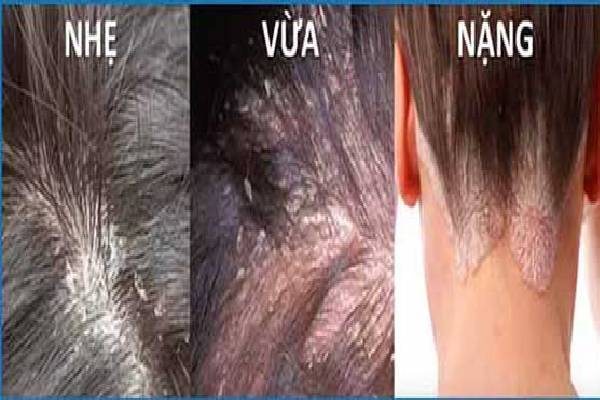 Những biểu hiện của nấm da đầu