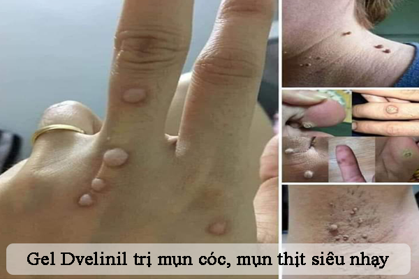 Hiệu quả rất tốt của Gel Dvelinil