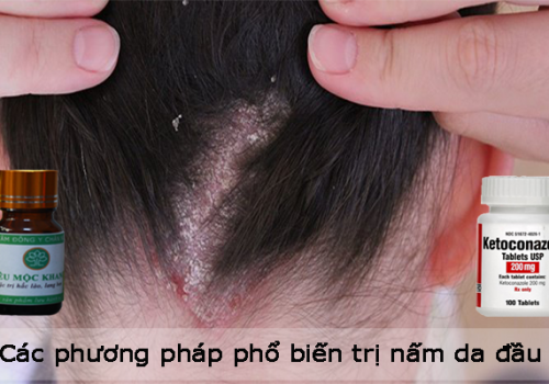 Các phương pháp phổ biến trị nấm da đầu hiện nay