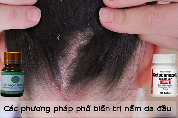 Các phương pháp phổ biến trị nấm da đầu hiện nay
