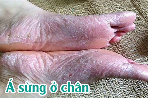 Triệu chứng của bệnh á sừng