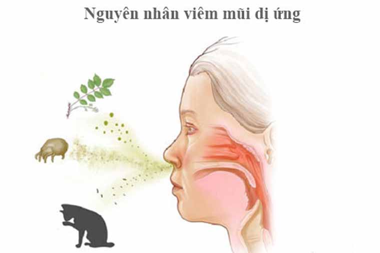 Nguyên nhân gây viêm mũi