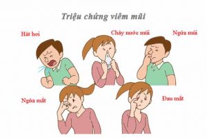 Triệu chứng viêm mũi vân mạch