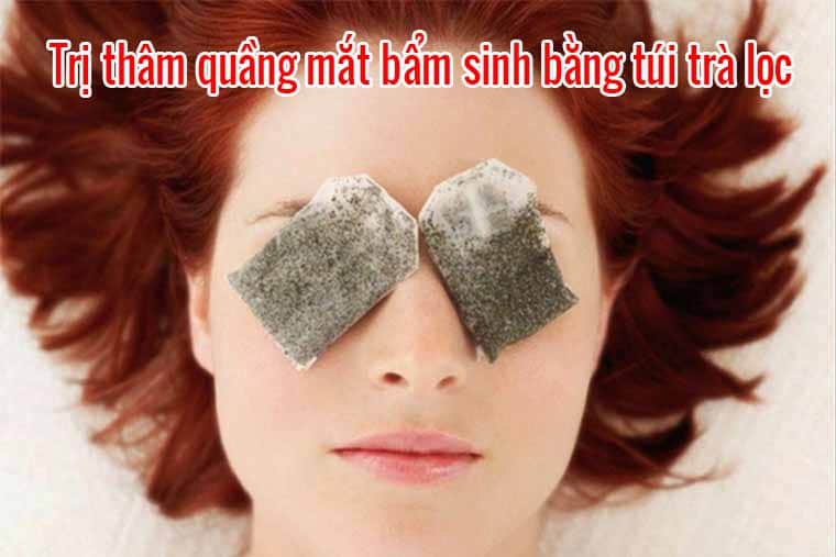 Trị thâm quầng mắt bẩm sinh bằng túi trà lọc