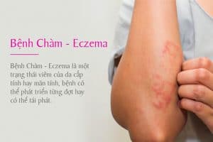 Hình ảnh bệnh chàm Eczema