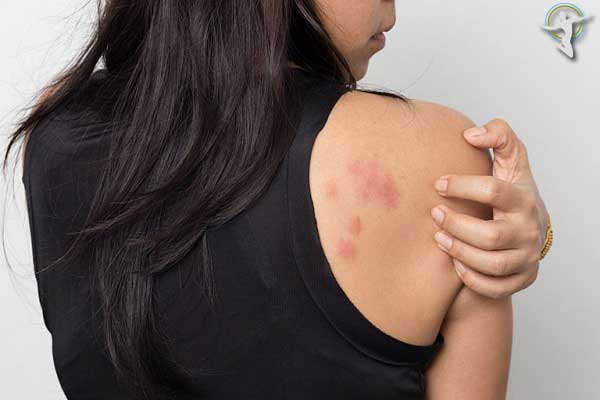 Bệnh mề đay cấp tính là một dạng dị ứng da, khởi phát đột ngột