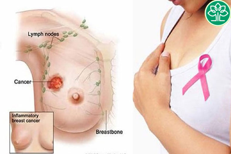 Tắc tia sữa là gì?