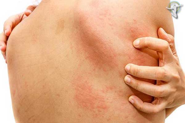 Khi bị mề đay cấp tính không nên dùng tay để gãi ngứa