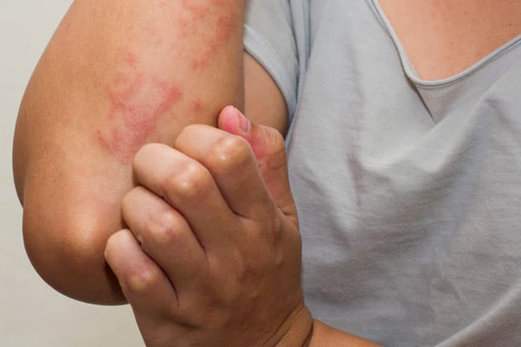 Việc cào gãi vùng da bị ngứa có thể khiến bệnh trầm trọng hơn