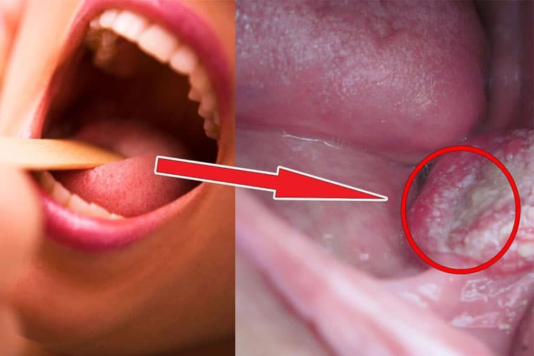 Dấu hiệu nhận biết ung thư vòm họng