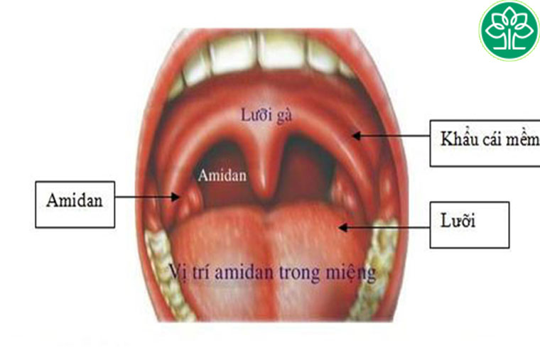 Do cấu trúc và vị trí của amidan nằm ngay ở điểm giao thoa giữa đường ăn, đường thở nên rất dễ mắc bệnh