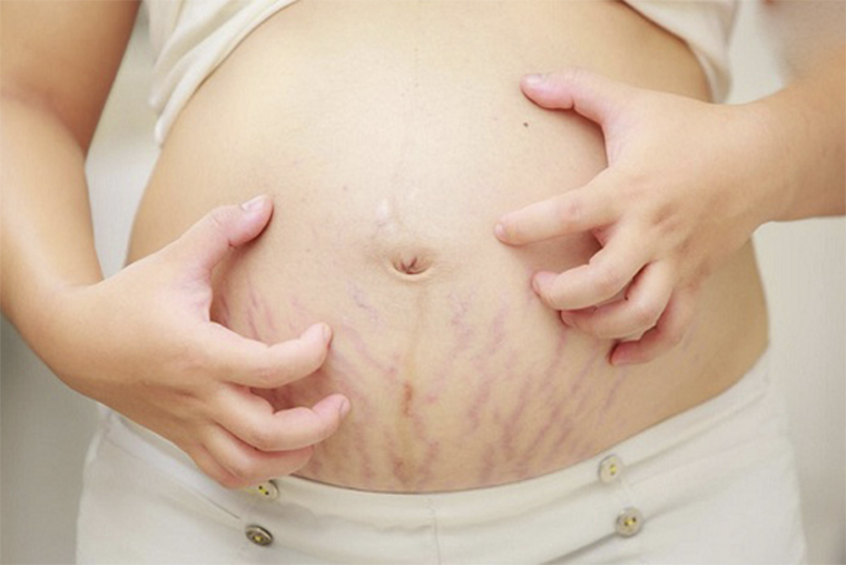 Khi mang thai, vùng da bụng bị giãn ra gây nổi mề đay
