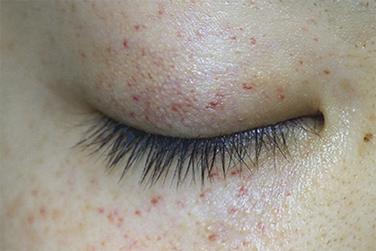 Nổi mề đay quanh mắt là một dạng dị ứng ngoài da ở khu vực mắt