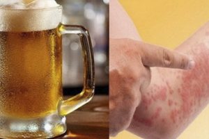 Trong bia có nhiều thành phần gây kích ứng cho da