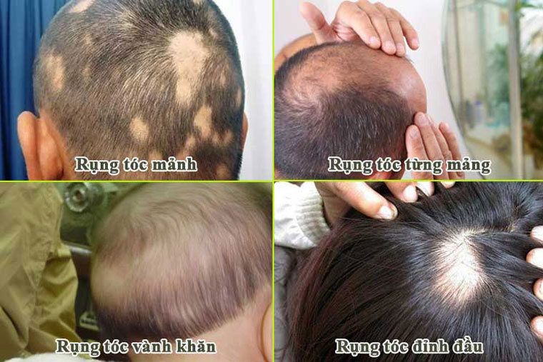 Căn cứ vào tình trạng rụng và khu vực có thể chia rụng tóc thành 4 dạng chính