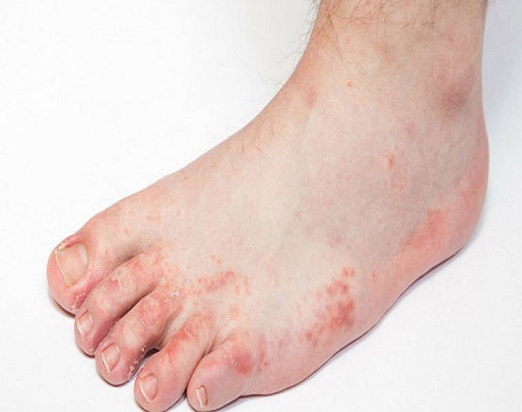 Các nốt mụn nước mọc khu trú ở các ngón chân