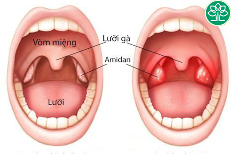 Vị trí của amidan trong khoang miệng