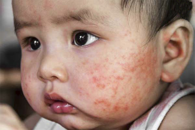 Hình ảnh viêm da cơ địa ở trẻ em trên vùng da mặt
