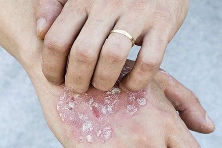 Viêm da cơ địa, vảy nến đều là bệnh ngoài da có một số biểu hiện giống nhau